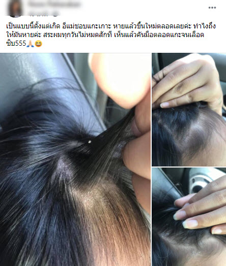ปัญหาหนังศรีษะลอก แม่เซ็งสระผมทุกวัน หายแล้วขึ้นใหม่ตลอด ปัญหาหนังศรีษะลอก แม่เซ็งสระผมทุกวัน หายแล้วขึ้นใหม่ตลอด